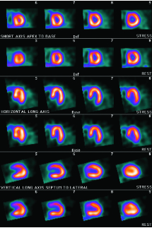 myocardial perfusion scan